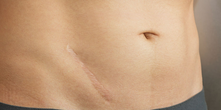 Cicatrices (post-chirurgie, acné, traumatiques)