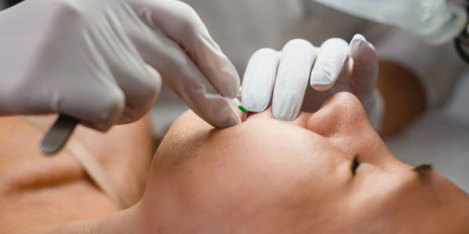 Epilation définitive