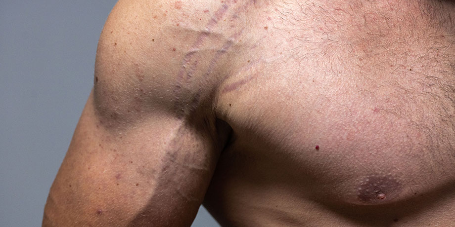 Dermopigmentation