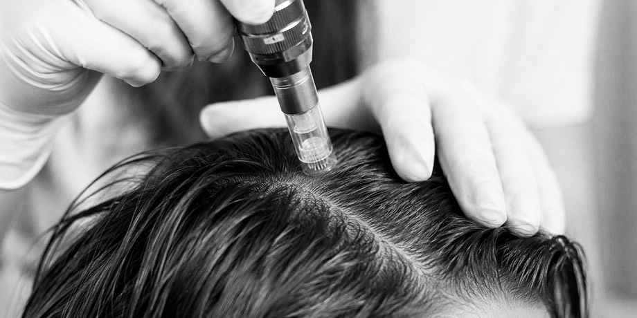 Microneedling