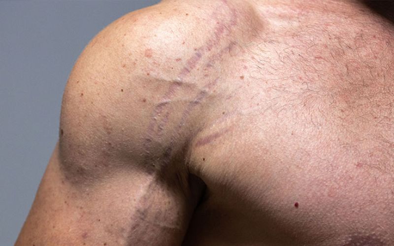 EMSCULPT — LE MUSCLE